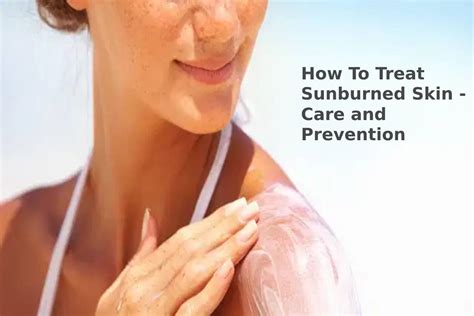 How To Treat Sunburned Skin Care And Prevention