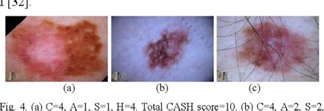 Figure 4 From Diagnosis Methods Of Skin Lesions In Dermoscopic Images