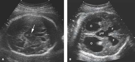 Ultrasound Neonatal Head Ventricles