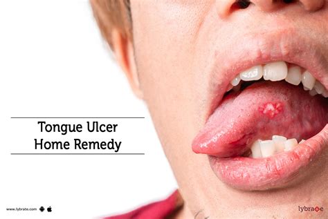Tongue Ulcer Home Remedy By Dr Ankita Priya Lybrate