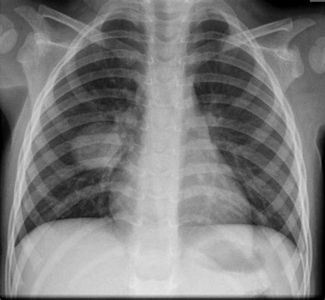 Write name, text on the cup online. Chest X-Ray Challenge! - PEM Blog