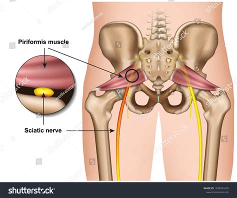 Piriformis Syndrome 3d Medical Vector Illustration Stock Vector
