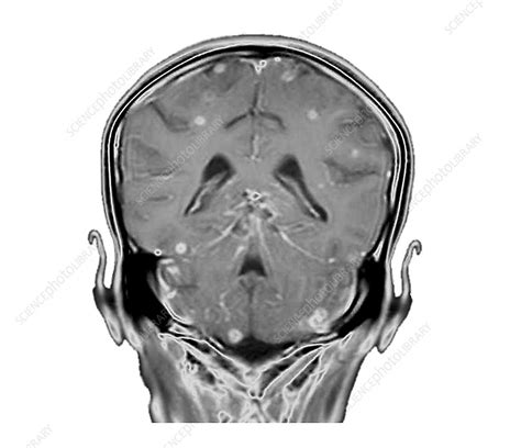 Secondary Brain Cancer Mri Scan Stock Image C0388540 Science