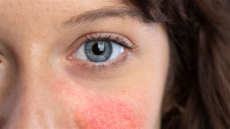 What Is Rosacea And What Can You Do About It