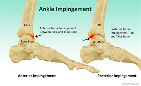 Anterior Ankle Impingement Book In At Podiatry Hq Clinics Today