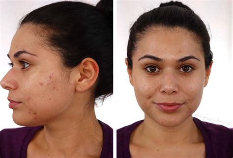 Going Dairy Free For Acne My 30 Day Results Slashed Beauty