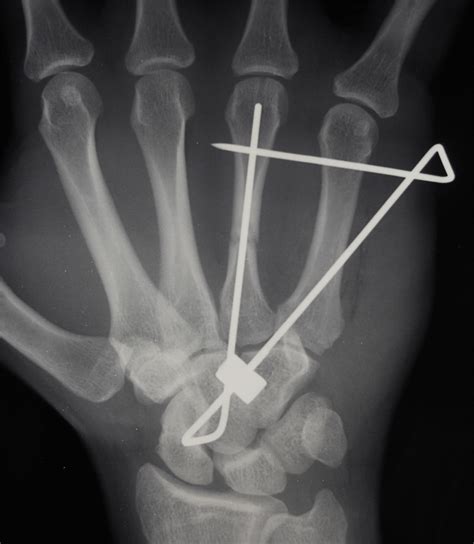 Non Thumb Extra Articular Metacarpal Fractures Percutaneous Locked
