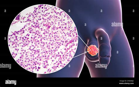 Testicular Cancer Illustration And Light Micrograph Stock Photo Alamy