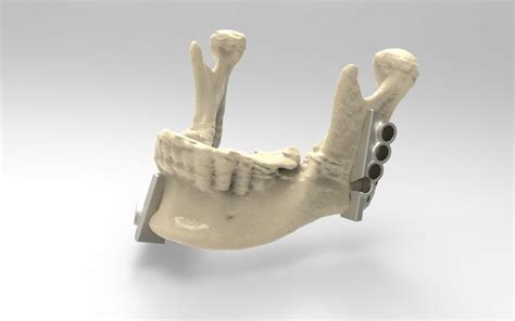 Pin On 3D Printing Orthopedics