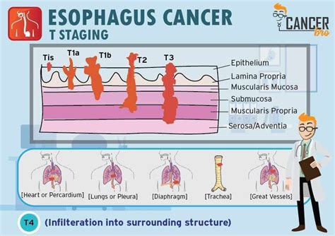Esophageal Cancer Tnm Staging Explained In Detail By Minakshi