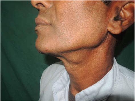 Preauricular Lymph Nodes Causes Of Swelling Salivary