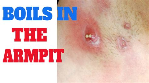 Boil In Armpit Symptoms Of Boil In Armpit Arm Pit Pus Underarm Bump Youtube