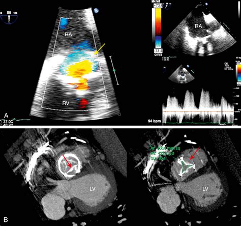 Tricuspid And Pulmonic Prosthetic Valves Clinical Tree