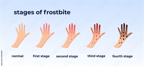 Frostbite Stages Hypothermia In Cold Season Medical Infographic Blue