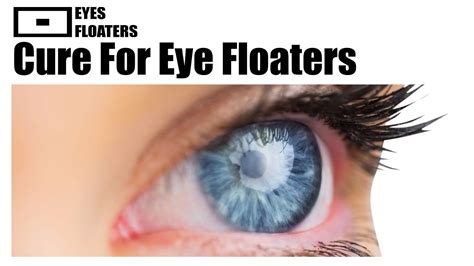 Cure For Eye Floaters Youtube