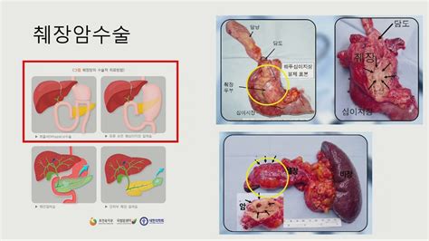 최근 들어 급격히 병세가 악화된 유. 최신 암수술기법 -간, 담관, 췌장암 : 외과 윤성필 과장 - YouTube