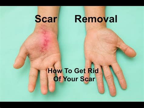 Scar Removal How To Get Rid Of Your Scar Youtube