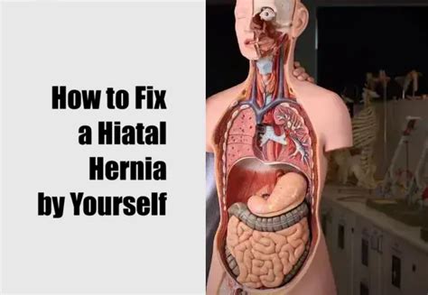 How To Fix A Hiatal Hernia By Yourself Health Advisor