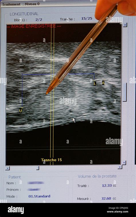 Cancer Of Prostate Ultrasound Stock Photo Alamy