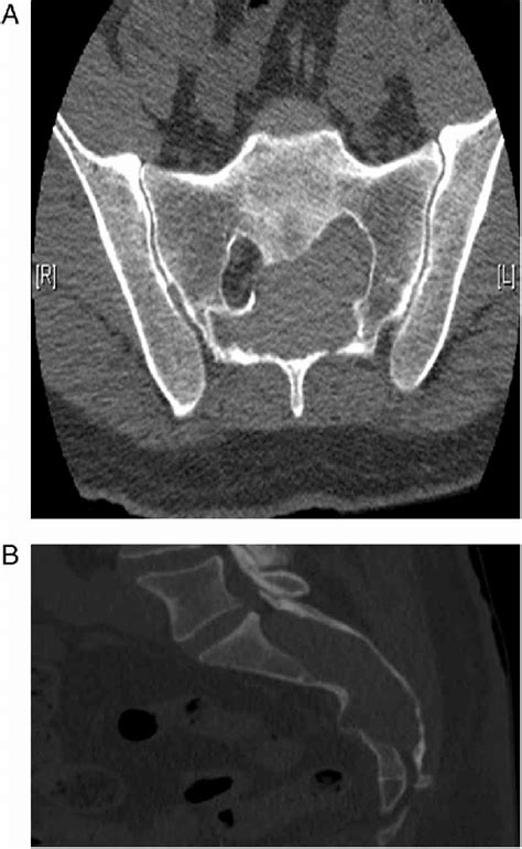 A And B Axial And Sagittal Ct Scan Showed A Large Lobulated Mass In