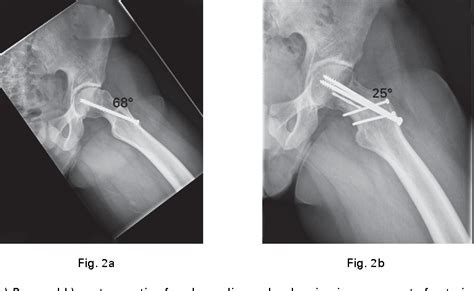 Figure 2 From Subcapital Osteotomy Of The Femoral Neck For Patients