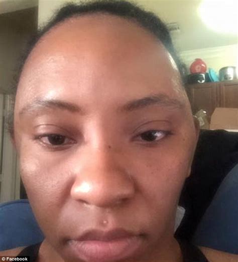 Chemese Armstrong Shares Photos After Allergic Reaction To Henna Hair Dye Daily Mail Online