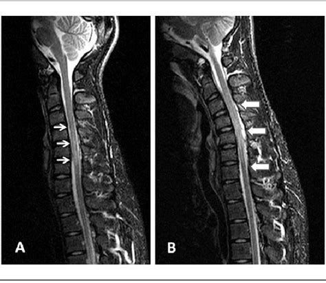 A The T2 Weighted Cervical Magnetic Resonance Imaging Mri Showed