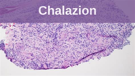 Chalazion Pathology Mini Tutorials Youtube
