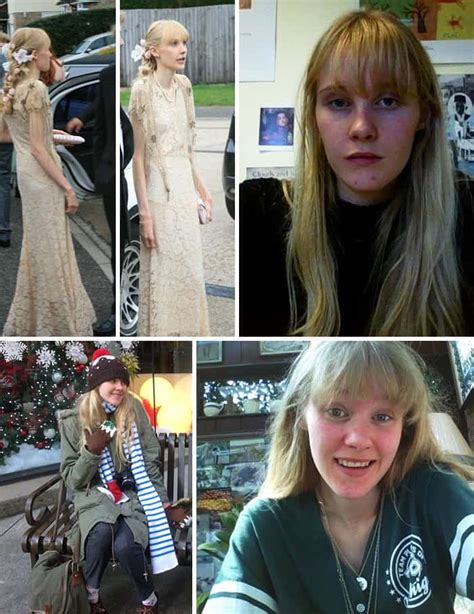 45 ‘before And After Photos Of People Who Beat Anorexia True Activist