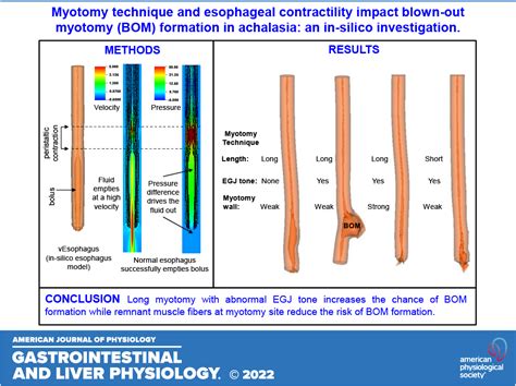Myotomy Technique And Esophageal Contractility Impact Blown Out Myotomy