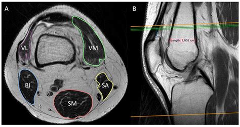 Diagnostics Free Full Text Knee Muscles Composition Using