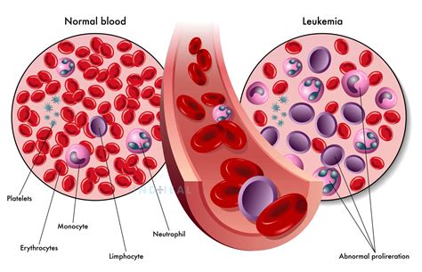 Different Types Of Blood Cancer And Its Treatment Indheal Best
