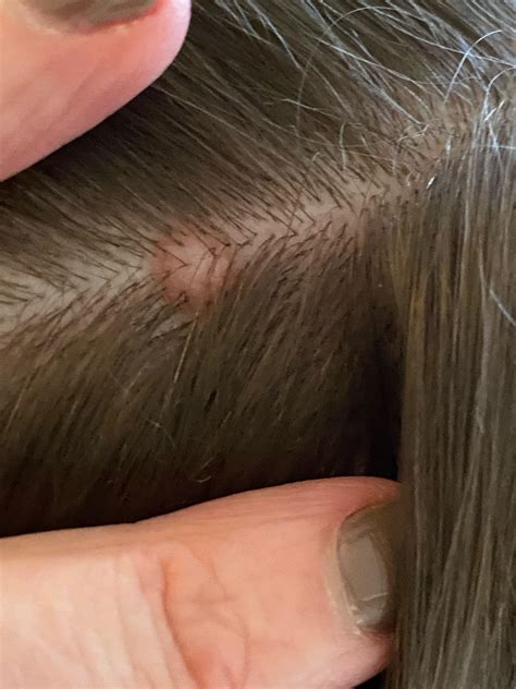 Redpink Mole On Scalp Melanoma