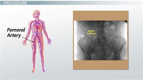 Angiogram Definition Complications And Types Lesson