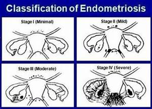 Endometriosis Stages And How They Are Measured