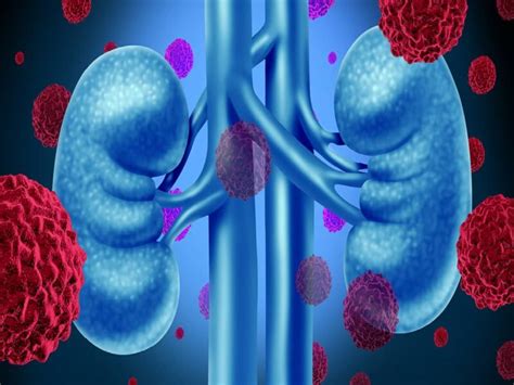 Kidney Cancer Types Symptoms Diagnosis And Treatment Sound Health