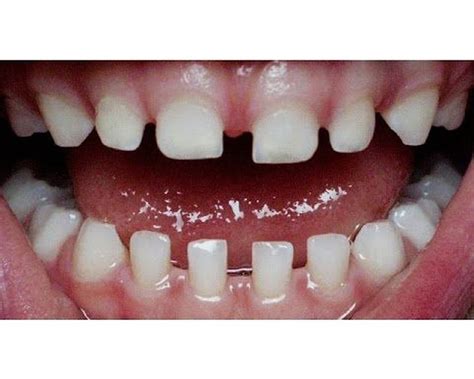 Características De Los Arcos Dentarios En Dentición Primaria Odontovida