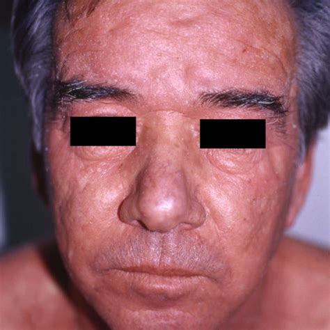 Hyperkeratosis Parakeratosis And Acanthosis In The Epidermis Of The