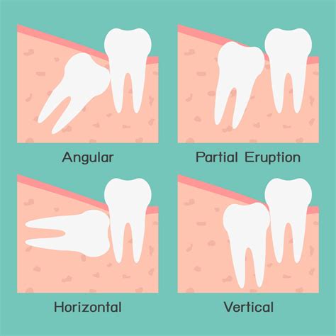 Wisdom Tooth Extractions Tewantin Dental Centre