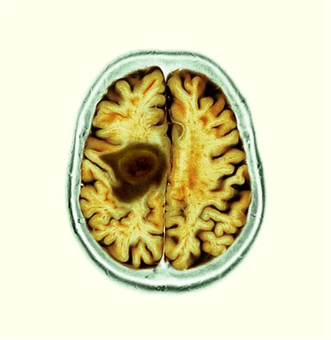 Glioblastoma Brain Cancer Ct Scan Physician Resource