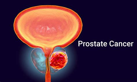 Darolutamide Increases Survival In Patients With Metastatic Hormone Sensitive Prostate Cancer Nejm
