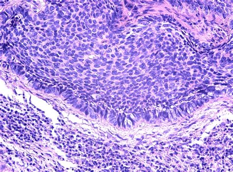 Nodular Basal Cell Carcinoma He Staining ×200 Download Scientific