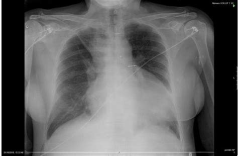 Frontal Chest Radiograph Showing Mild Cardiomegaly And Opacification