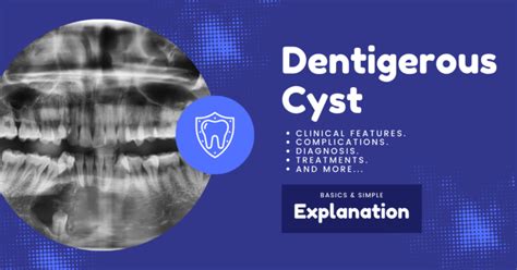 Dentigerous Cyst Clinical Features Radiography Complications