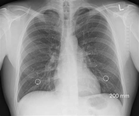 Study Shows Chest X Rays Miss Up To A Fifth Of Lung Cancer Cases Cantest