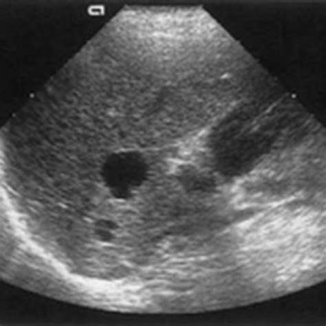 Ultrasound Images Simple Cysts Radiology Imaging