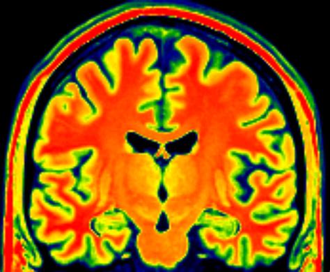 What Is Brain Shrinkageatrophy In Dementia