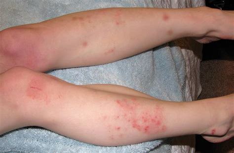 Severe Eczema Effectively Treated With Xeljanz Tofacitinib An