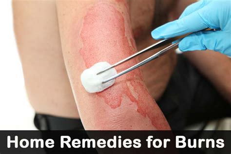 Home Remedies And Natural Cures For Minor Skin Burns
