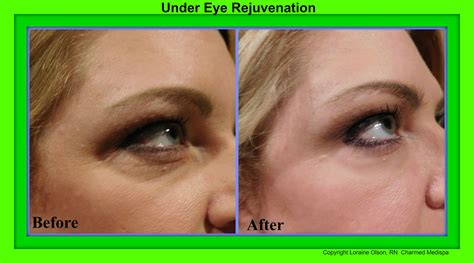 Laser For Under Eye Wrinkles Before And After